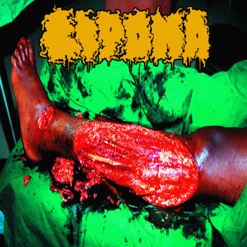 Lipoma : Dermatologic Manifestations - Eternal Sufferings